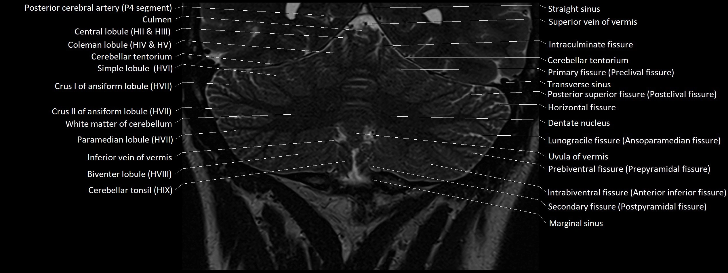 Anatomy of cerebellum coronal cross sectional 3T image 17.webp